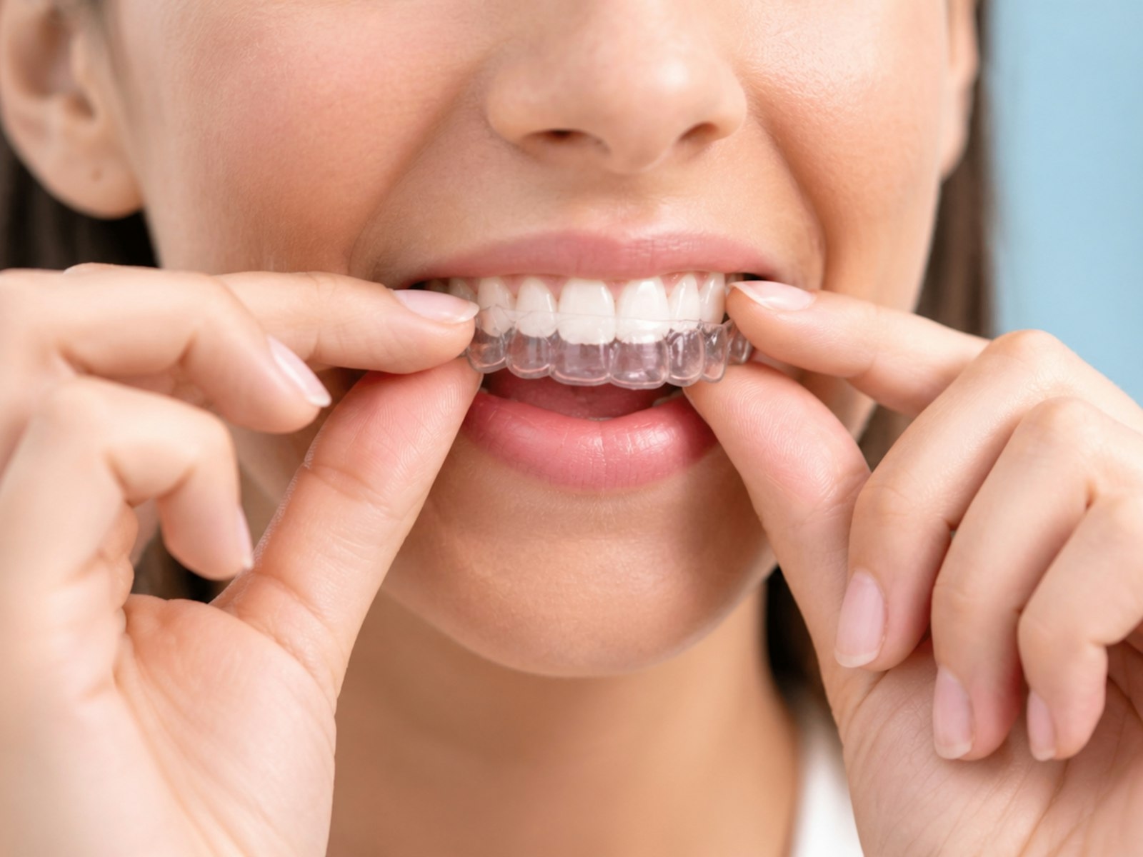 A person fitting a clear aligner over their teeth.
