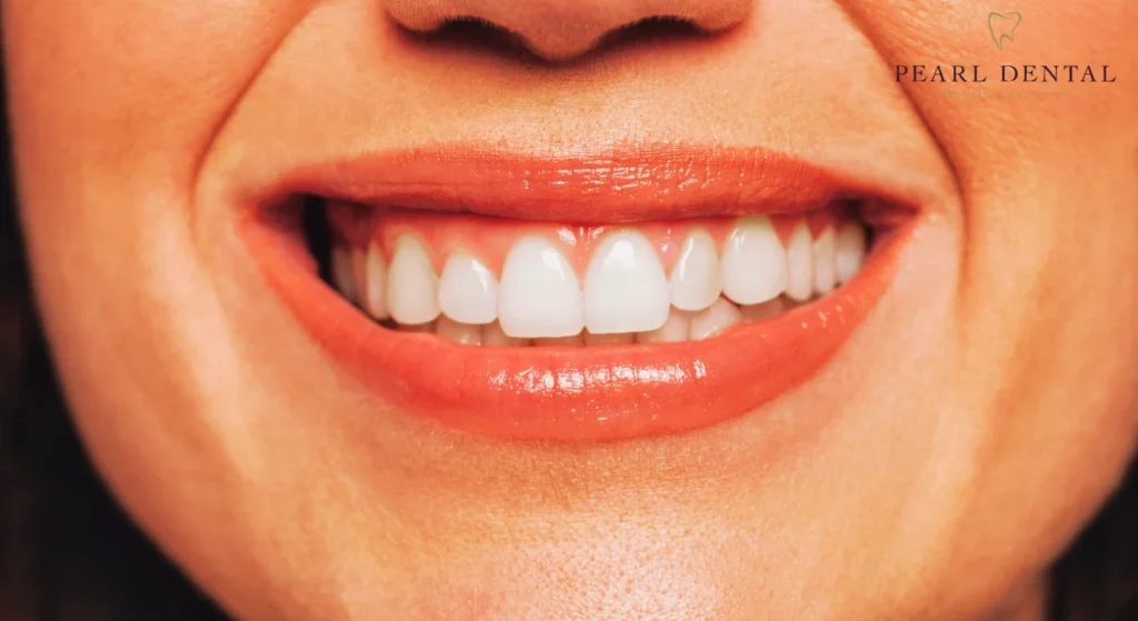 What happens to my teeth under composite bonding?
